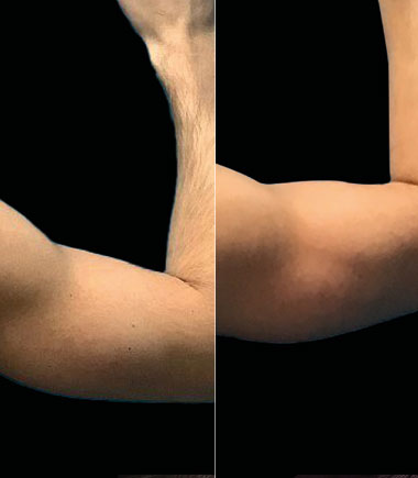 NeoSculpt body contouring before and after abdomen results