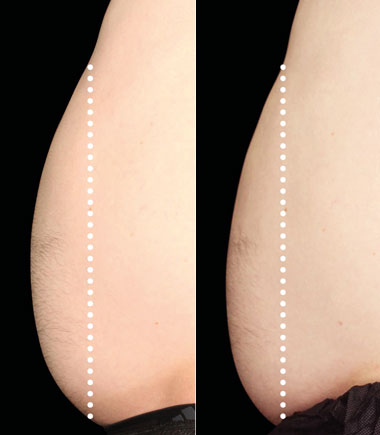 NeoSculpt fat reduction and muscle building before and after results
